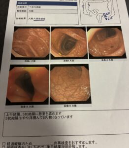 大腸内視鏡検査の結果表(2024年・大腸憩室症)
